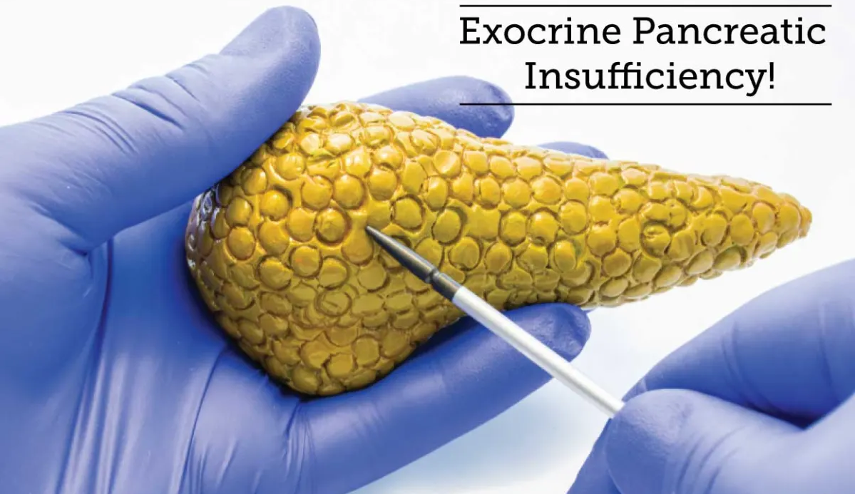 Know about Pancreatic Insufficiency (EPI): Causes, Symptoms, Diagnosis, Complications and Treatment